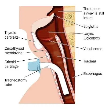 Rusch Tracheostomy Tube Cuffed